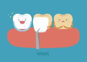 veneers covered by dental insurance