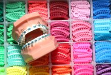 best colors for braces