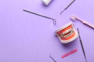 Brighten Up Your Smile with lilac and Violet Braces
