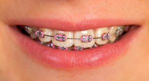 Pink and Purple Braces