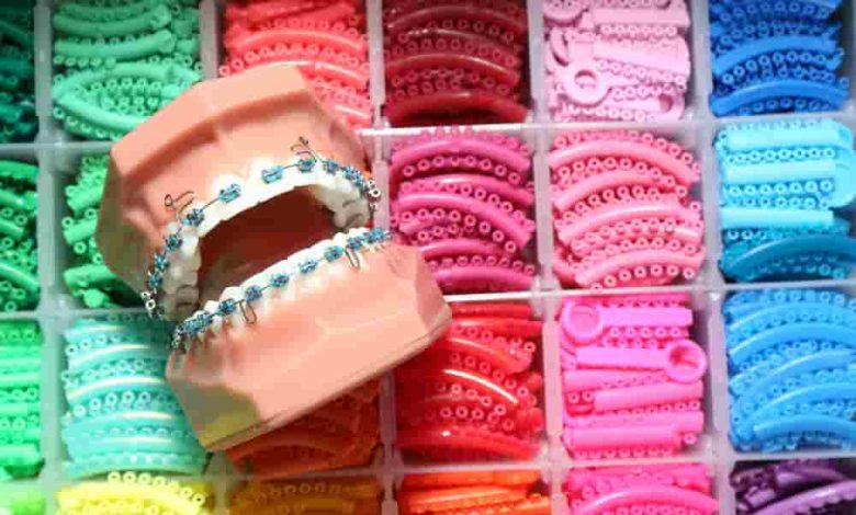 Pink and Purple Braces Color Your Style