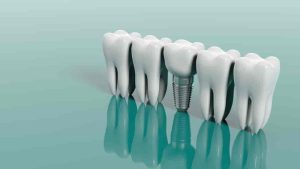 dental implant grants for seniors