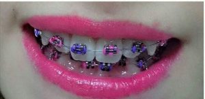 purple and pink braces