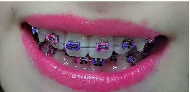 Trending Pink and Purple Braces: Color Your Style